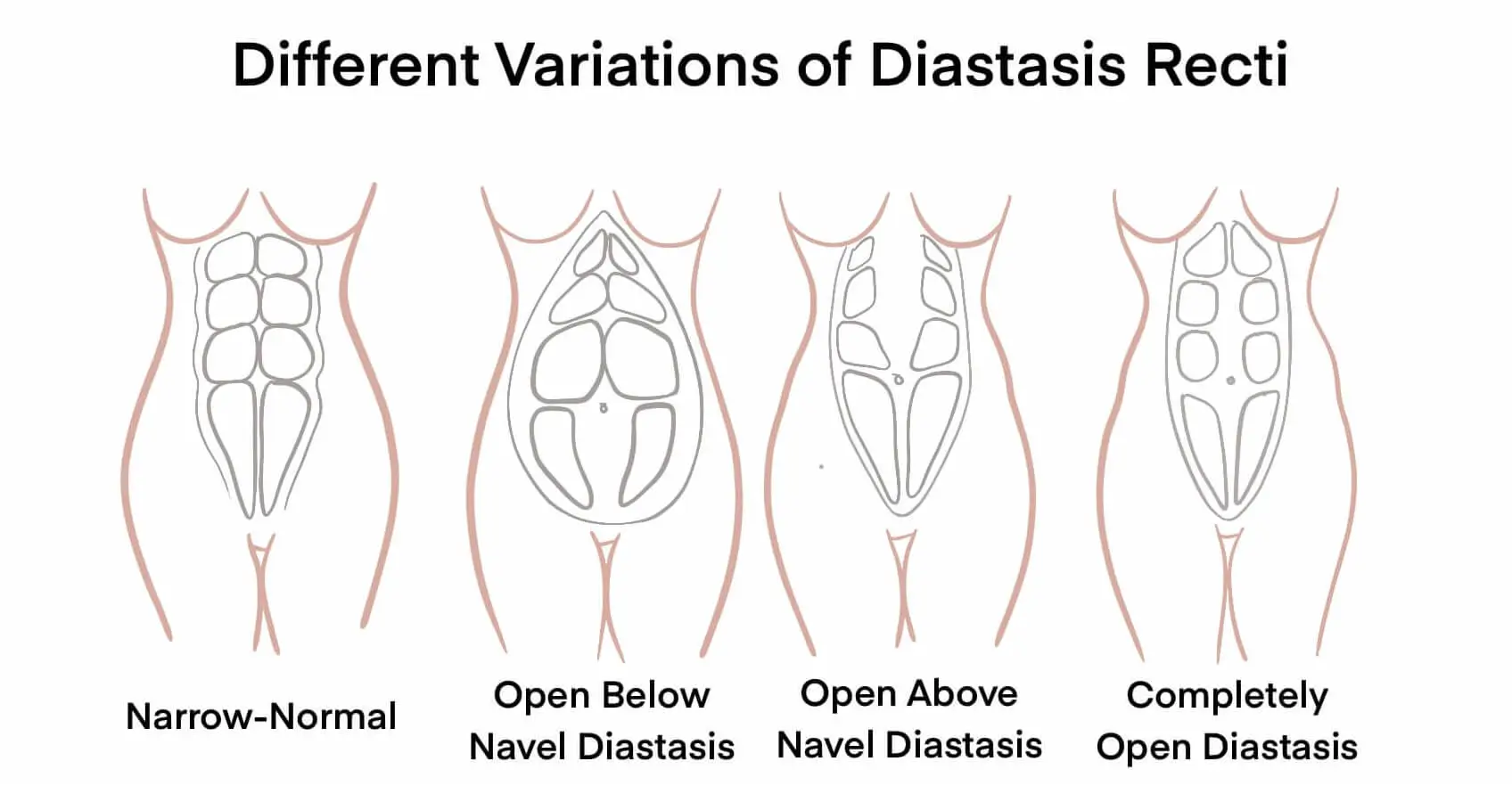 Diagram showing different variations of diastasis recti, including narrow-normal, open below navel, open above navel, and completely open diastasis, illustrating abdominal muscle separation in women.